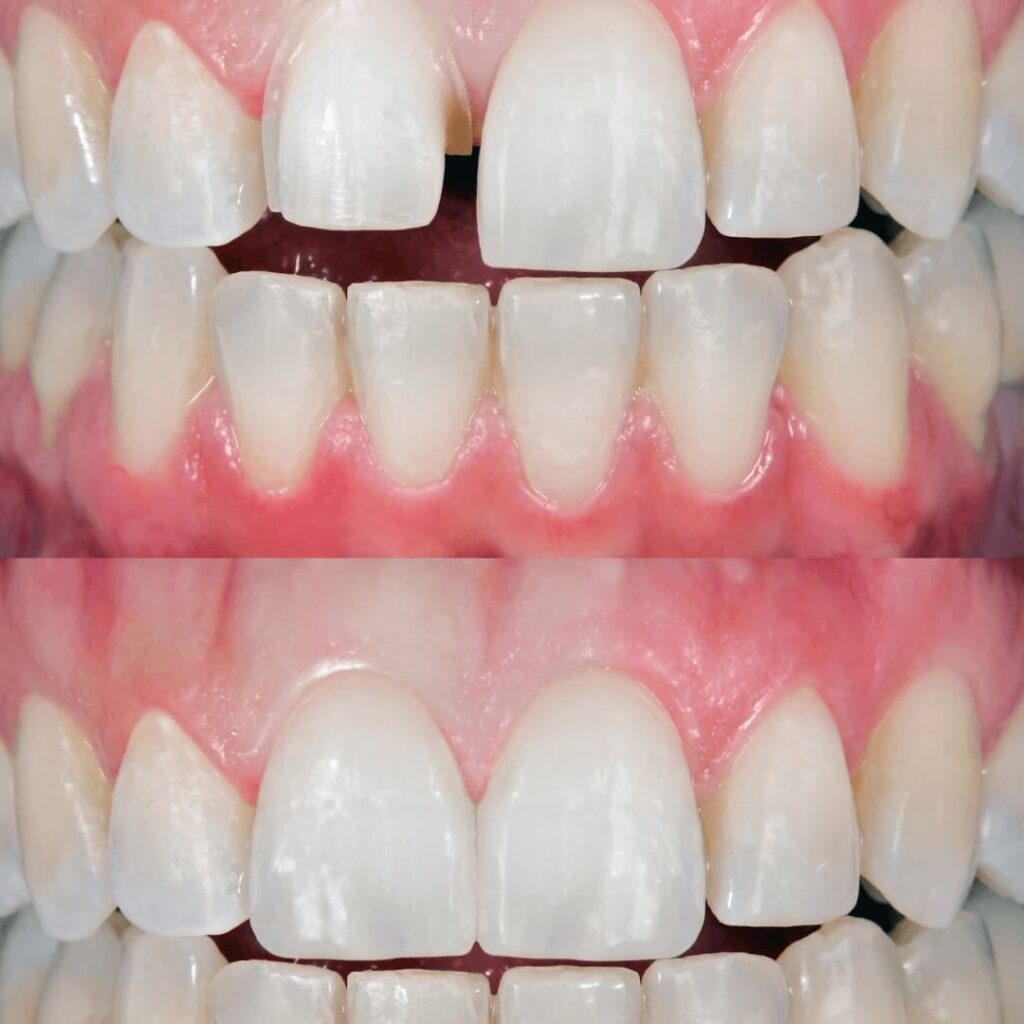 proceso de carillas dentales precio cdmx