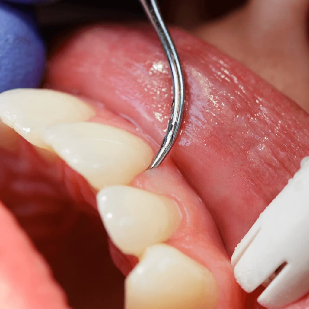 proceso de una limpieza dental con ultrasonido cdmx