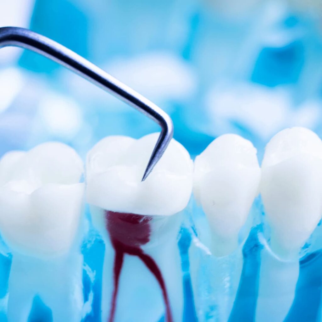 curetaje para una limpieza dental profunda cdmx