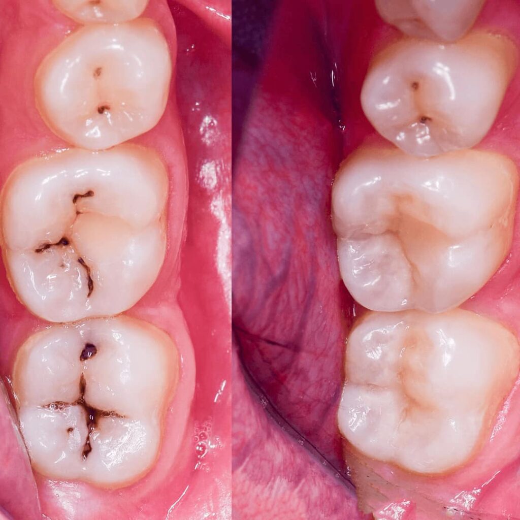 antes y después de una resina dental precio cdmx