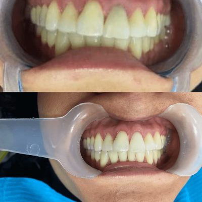 foto después de un blanqueamiento de dientes precio cdmx