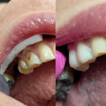 foto de aplicación de resinas de dientes